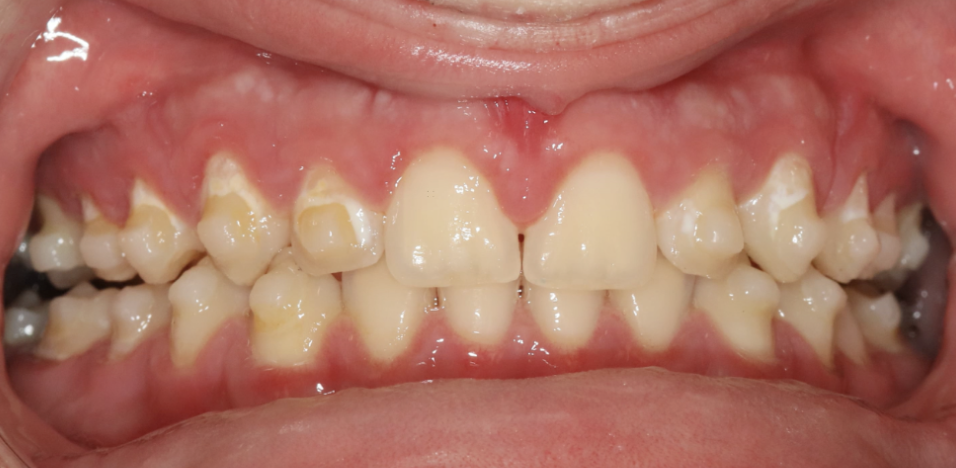 tipping molar illustration